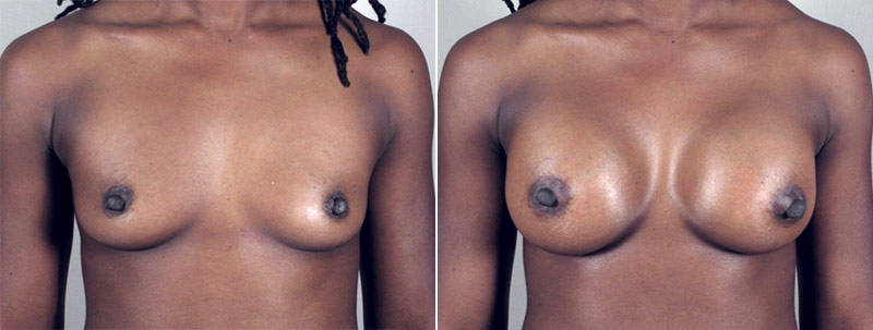 Breast Enlargement (Augmentation) Patient 22