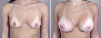 Breast Enlargement (Augmentation) Patient 23