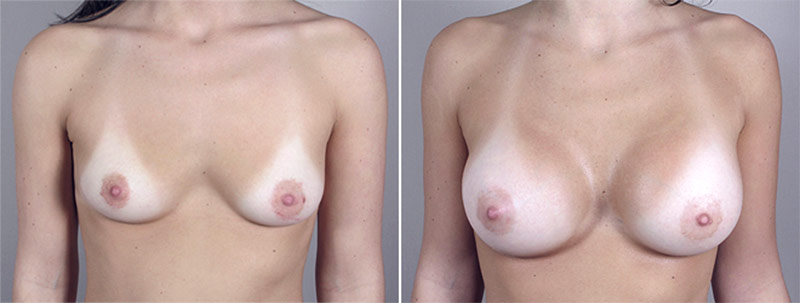 Breast Enlargement (Augmentation) Patient 23