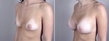 Breast Enlargement (Augmentation) Patient 23