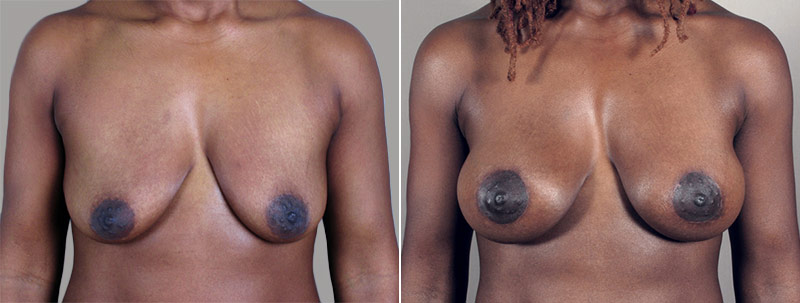 Breast Lift with Implants Patient 6
