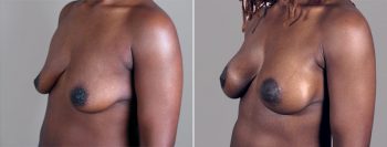 Breast Lift with Implants Patient 6