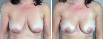 Parker Tummy Tuck Patient 9