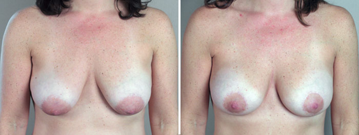 Parker Tummy Tuck Patient 9