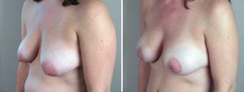 Parker Tummy Tuck Patient 9