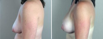 Parker Tummy Tuck Patient 9