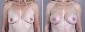 Mommy Makeover Patient 8