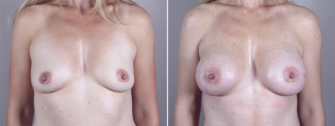 Mommy Makeover Patient 8