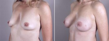 Mommy Makeover Patient 8