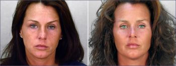 Cheek Implants Patient 1