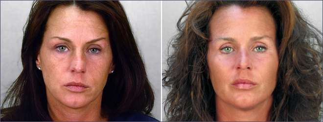 Cheek Implants Patient 1