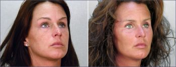 Cheek Implants Patient 1