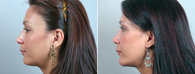 Chin Implant Patient 5