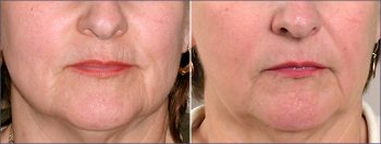 Wrinkle Reduction Patient 3 – Dermabrasion