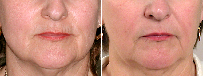 Wrinkle Reduction Patient 3 – Dermabrasion