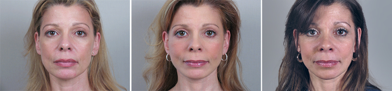 Facelift Patient 6