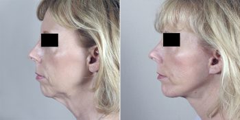 Facelift Patient 11