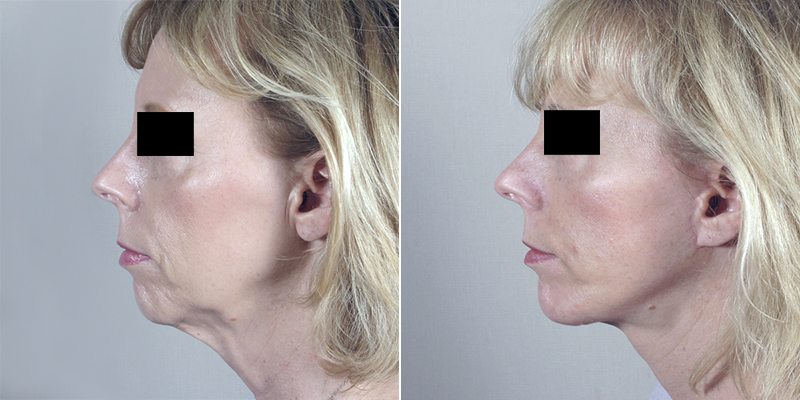 Facelift Patient 11