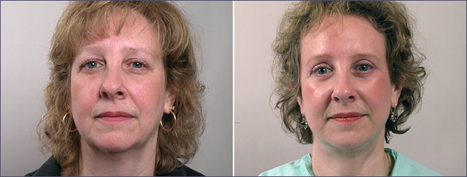 Facelift Patient 2
