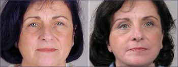 Facelift Patient 3
