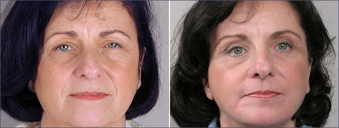 Facelift Patient 3