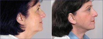 Facelift Patient 3