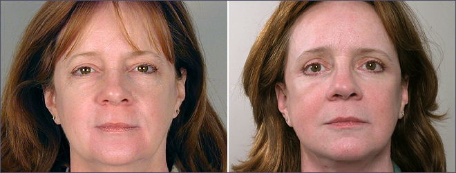 Facelift Patient 4