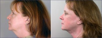 Facelift Patient 4