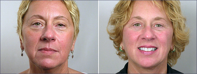 Facelift Patient 5