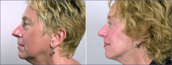 Facelift Patient 5