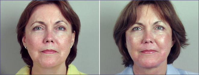 Facelift Patient 8