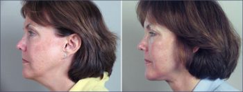 Facelift Patient 8