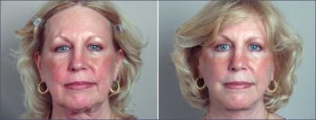 Facelift Patient 9