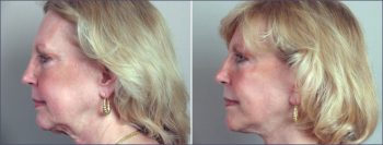 Facelift Patient 9