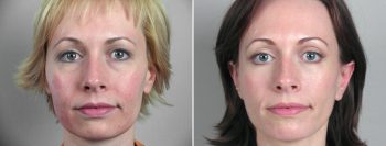 Facelift Patient 10