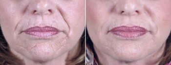 Botox® Cosmetic with Juvederm Patient 4