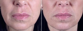 Facial Fillers Patient 5 – Perlane
