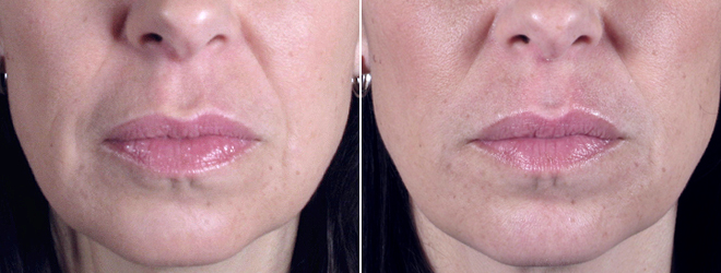 Facial Fillers Patient 5 – Perlane