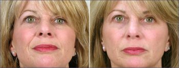 Facial Fillers Patient 1 – Restylane