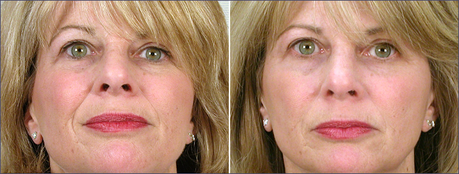 Facial Fillers Patient 1 – Restylane