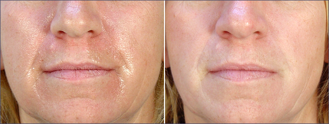 Facial Fillers Patient 3 – Captique
