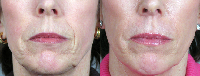 Facial Fillers Patient 2 – Restylane