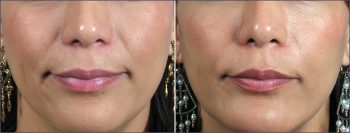 Facial Fillers Patient 4 – Restylane