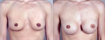 Breast Enlargement (Augmentation) Patient 25