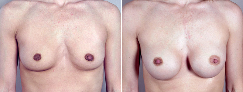 Breast Enlargement (Augmentation) Patient 25