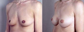 Breast Enlargement (Augmentation) Patient 25