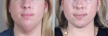 Neck Liposuction Patient 3