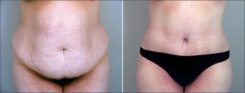 Parker Tummy Tuck Patient 8