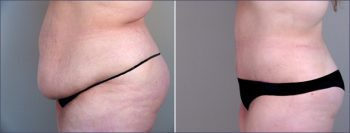Parker Tummy Tuck Patient 8