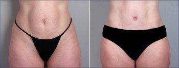 Parker Tummy Tuck Patient 10